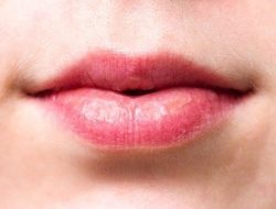 6 Penyebab Bibir Kering, yang Terakhir karena Penyakit